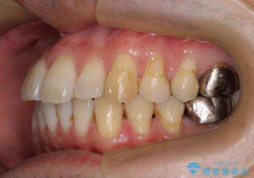 短期間で口元の印象をガラリと変えませんか? 30代男性 インビザライン矯正で自然な口元美を実現の治療中