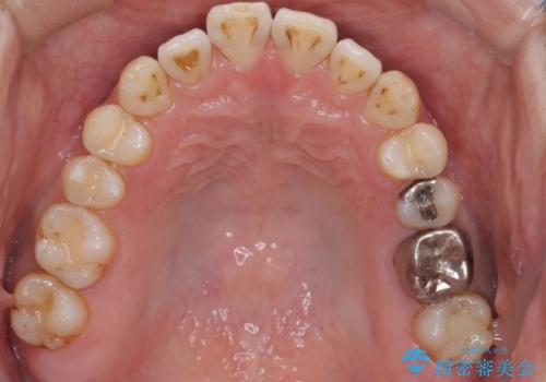 短期間で口元の印象をガラリと変えませんか? 30代男性 インビザライン矯正で自然な口元美を実現の治療中