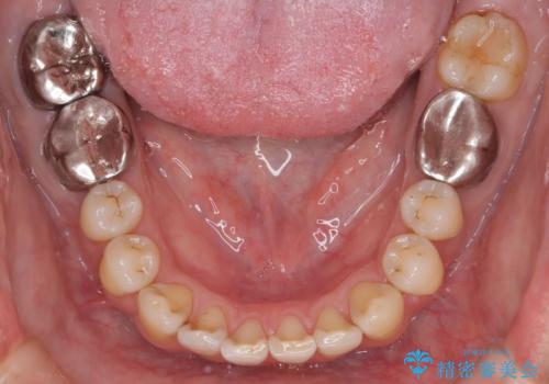 短期間で口元の印象をガラリと変えませんか? 30代男性 インビザライン矯正で自然な口元美を実現の治療中