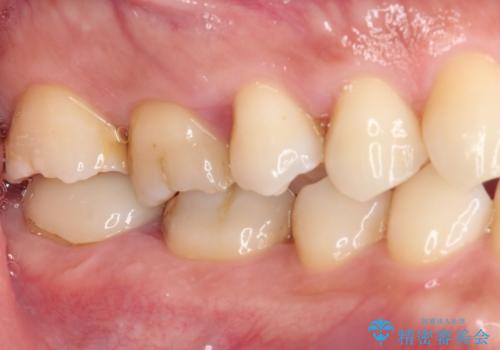 歯肉が腫れて出血する奥歯　歯周外科処置を用いたセラミック補綴治療の症例 治療前