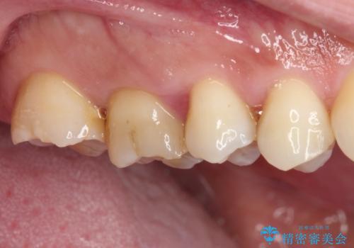 歯肉が腫れて出血する奥歯　歯周外科処置を用いたセラミック補綴治療の治療前