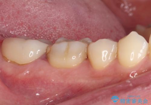 歯肉が腫れて出血する奥歯 歯周外科処置を用いたセラミック補綴治療の治療前