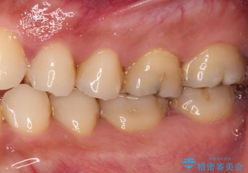 歯肉が腫れて出血する奥歯 歯周外科処置を用いたセラミック補綴治療の治療前