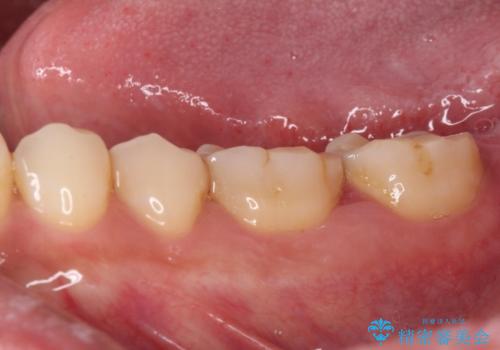 歯肉が腫れて出血する奥歯　歯周外科処置を用いたセラミック補綴治療の治療前