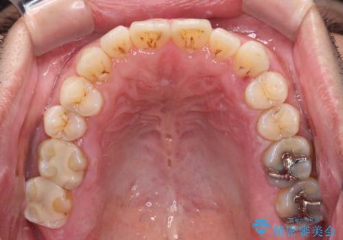 歯肉が腫れて出血する奥歯 歯周外科処置を用いたセラミック補綴治療の治療前