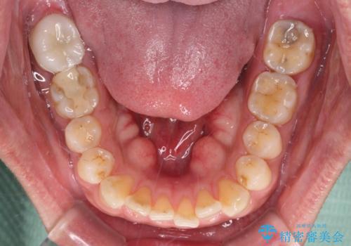 歯肉が腫れて出血する奥歯 歯周外科処置を用いたセラミック補綴治療の治療前