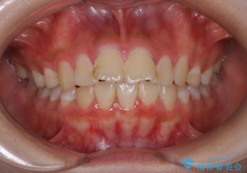 【インビザライン】前歯を下げたいの治療前