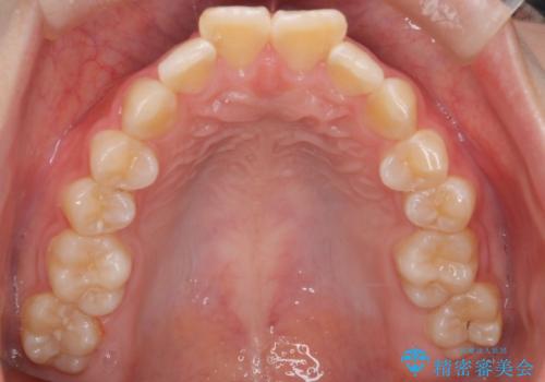 【インビザライン】前歯を下げたいの治療前