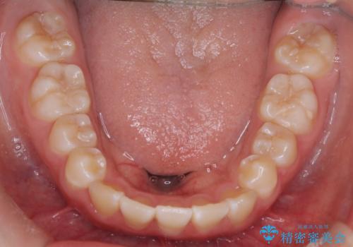 【インビザライン】前歯を下げたいの治療前