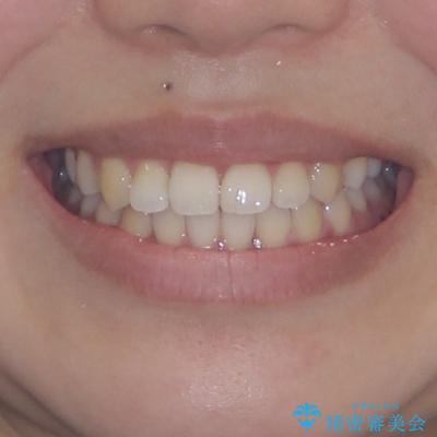 前歯のデコボコを楽して改善　ワイヤー装置による矯正治療の治療後（顔貌）
