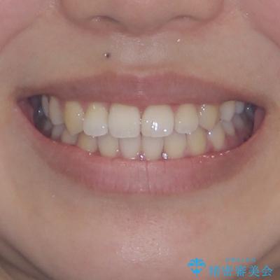 前歯のデコボコを楽して改善 ワイヤー装置による矯正治療の治療後(顔貌)
