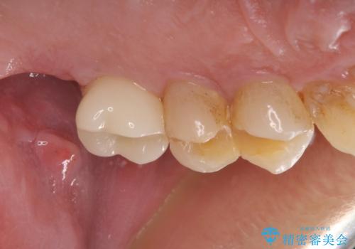 根管治療を行ったままの奥歯 オールセラミッククラウンによる補綴治療の治療前