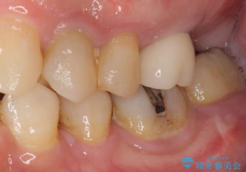 根管治療を行ったままの奥歯 オールセラミッククラウンによる補綴治療の治療前