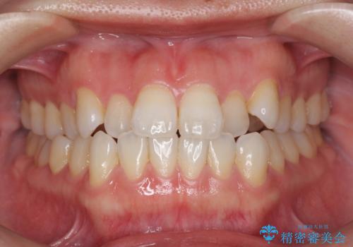 受け口傾向のマウスピース矯正 (ワイヤー治療を併用して)の症例 治療前