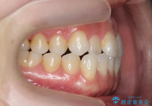 受け口傾向のマウスピース矯正 (ワイヤー治療を併用して)の治療前