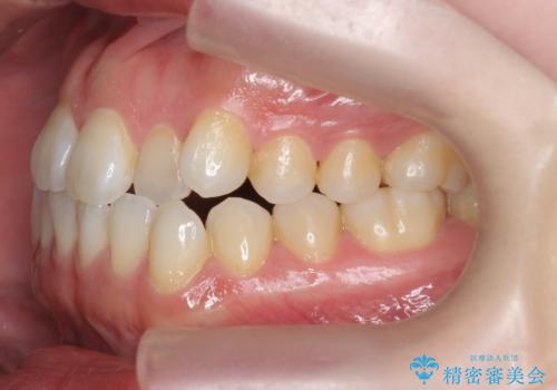 受け口傾向のマウスピース矯正 (ワイヤー治療を併用して)の治療前