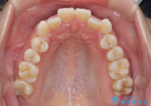 受け口傾向のマウスピース矯正 (ワイヤー治療を併用して)の治療前