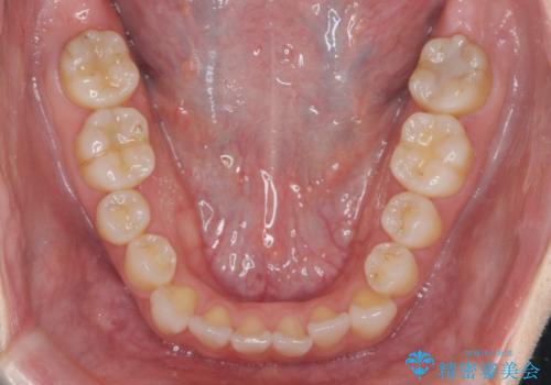 受け口傾向のマウスピース矯正 (ワイヤー治療を併用して)の治療前