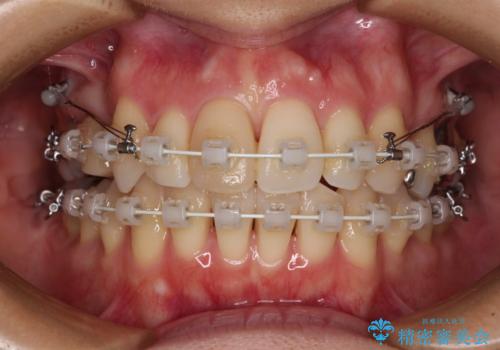 V字型に飛び出した前歯 ワイヤー装置での抜歯矯正の治療中