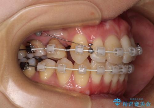 V字型に飛び出した前歯　ワイヤー装置での抜歯矯正の治療中