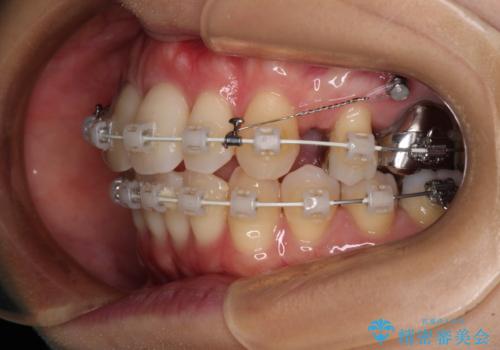 V字型に飛び出した前歯　ワイヤー装置での抜歯矯正の治療中