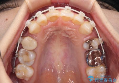V字型に飛び出した前歯 ワイヤー装置での抜歯矯正の治療中