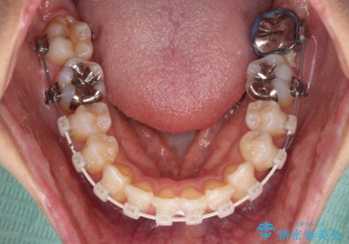 V字型に飛び出した前歯 ワイヤー装置での抜歯矯正の治療中