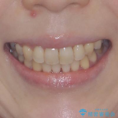 大きなむし歯の奥歯を抜歯してスペースを活用　ワイヤー装置による抜歯矯正の治療後（顔貌）