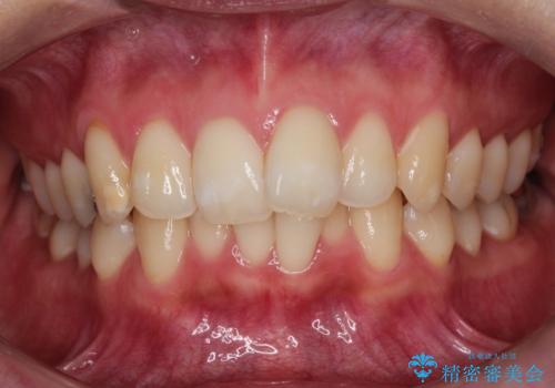 驚くほど短期間で前歯のガタツキを解消!　マウスピース矯正の効果の症例 治療前