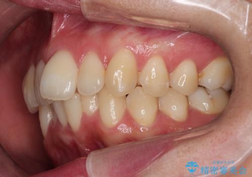 驚くほど短期間で前歯のガタツキを解消! マウスピース矯正の効果の治療前
