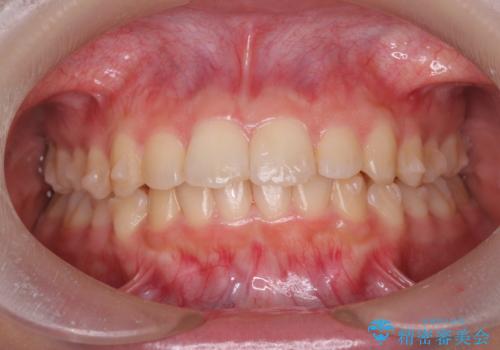 半年で行えるマウスピース矯正の治療中