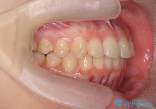 半年で行えるマウスピース矯正の治療中