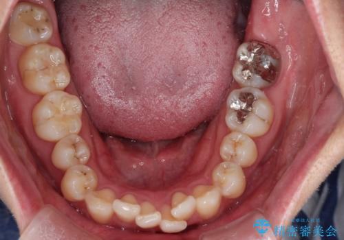 驚くほど短期間で前歯のガタツキを解消! マウスピース矯正の効果の治療前