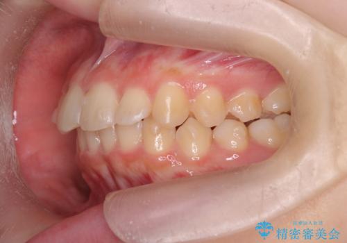 半年で行えるマウスピース矯正の治療中