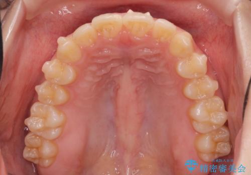 半年で行えるマウスピース矯正の治療中