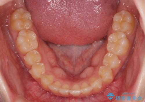 半年で行えるマウスピース矯正の治療中