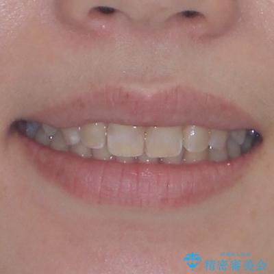 上の出っ歯を治したい インビザラインによる矯正治療の治療後(顔貌)