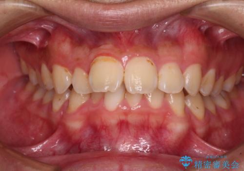 【モニター】飛び出した上の前歯 ワイヤー装置を併用してインビザラインできれいにの治療前