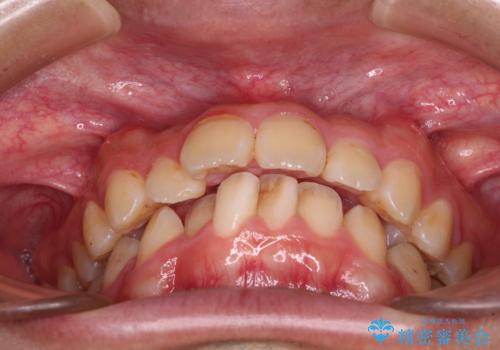 【モニター】飛び出した上の前歯 ワイヤー装置を併用してインビザラインできれいにの治療前