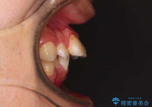 【モニター】飛び出した上の前歯 ワイヤー装置を併用してインビザラインできれいにの治療前