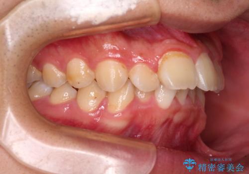 【モニター】飛び出した上の前歯 ワイヤー装置を併用してインビザラインできれいにの治療前