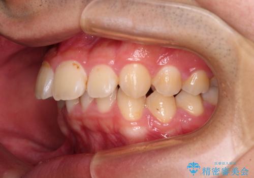 【モニター】飛び出した上の前歯 ワイヤー装置を併用してインビザラインできれいにの治療前