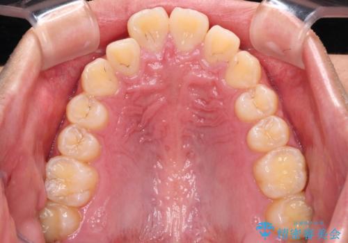 【モニター】飛び出した上の前歯 ワイヤー装置を併用してインビザラインできれいにの治療前