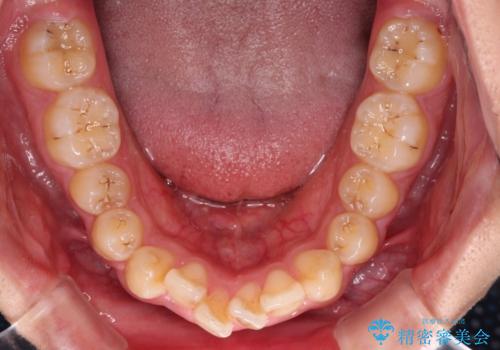 【モニター】飛び出した上の前歯 ワイヤー装置を併用してインビザラインできれいにの治療前