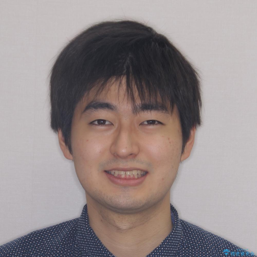 【モニター】飛び出した上の前歯 ワイヤー装置を併用してインビザラインできれいにの治療前(顔貌)