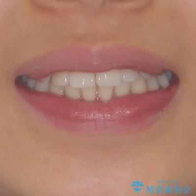 カリエール・ディスタライザーを併用したインビザライン矯正治療の治療前(顔貌)