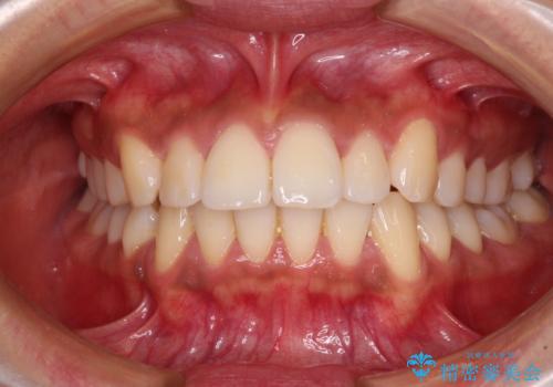 カリエール・ディスタライザーを併用したインビザライン矯正治療の症例 治療前