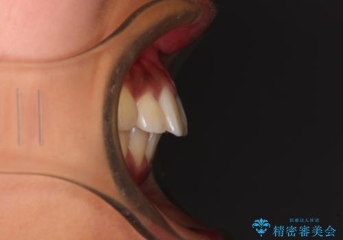 カリエール・ディスタライザーを併用したインビザライン矯正治療の治療前