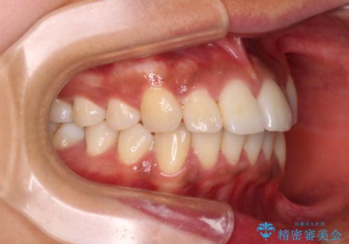 カリエール・ディスタライザーを併用したインビザライン矯正治療の治療前