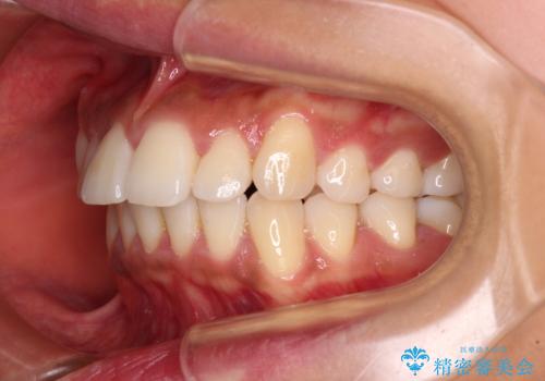 カリエール・ディスタライザーを併用したインビザライン矯正治療の治療前